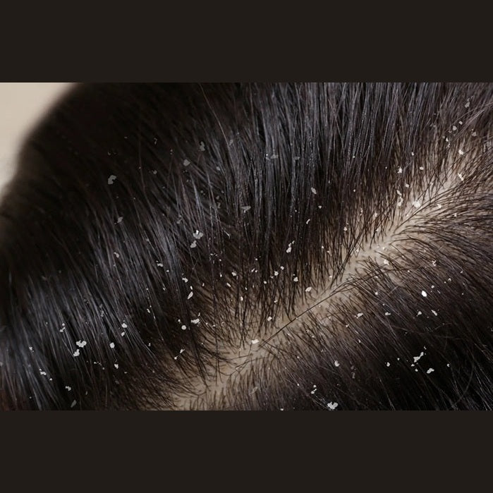 Kəpəyə qarşı vasitələr