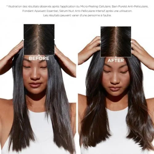 Həssas baş dərisi və kəpəyə qarşı piling